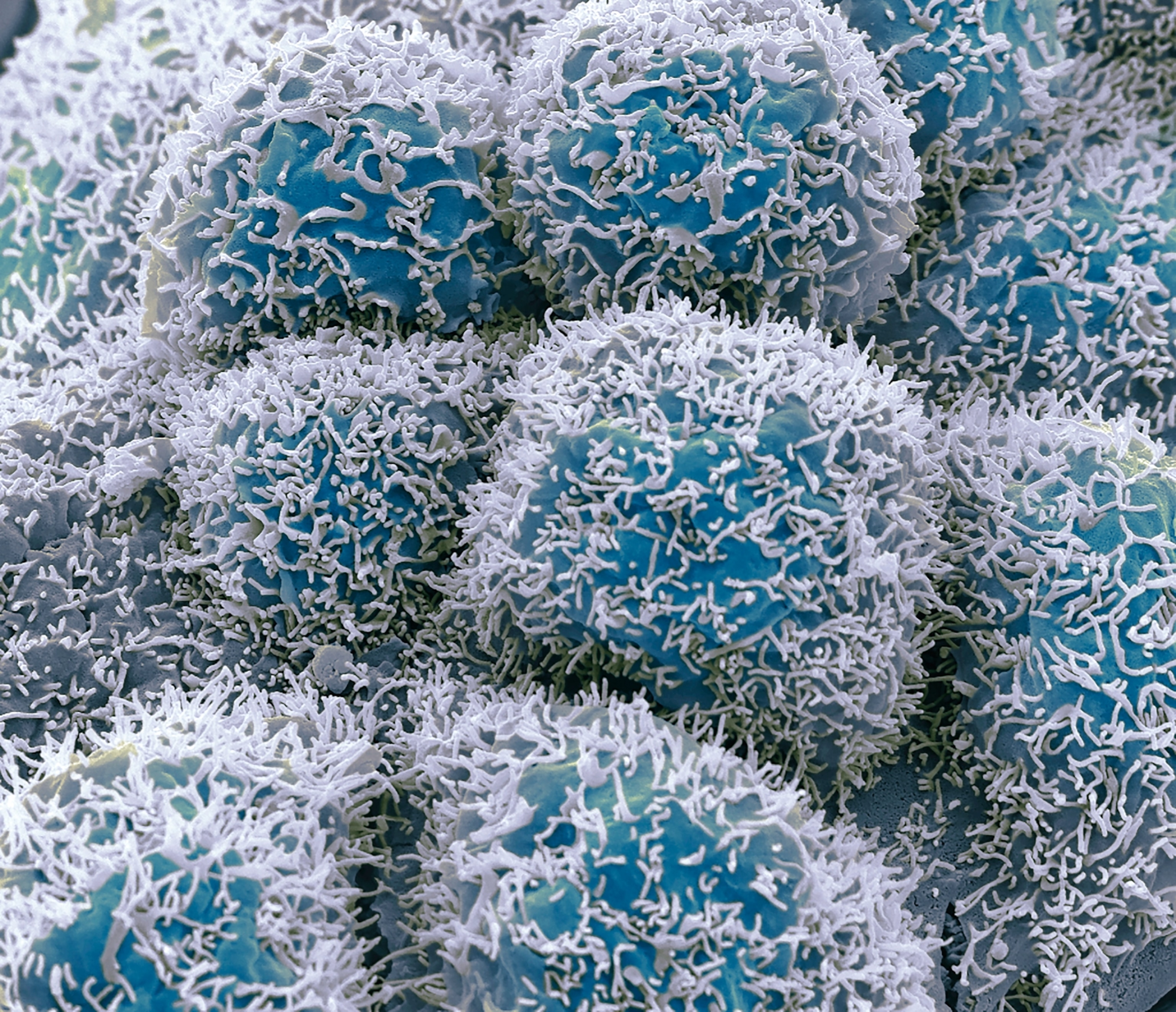 Colorized scanning electron micrograph of colorectal cancer cells.