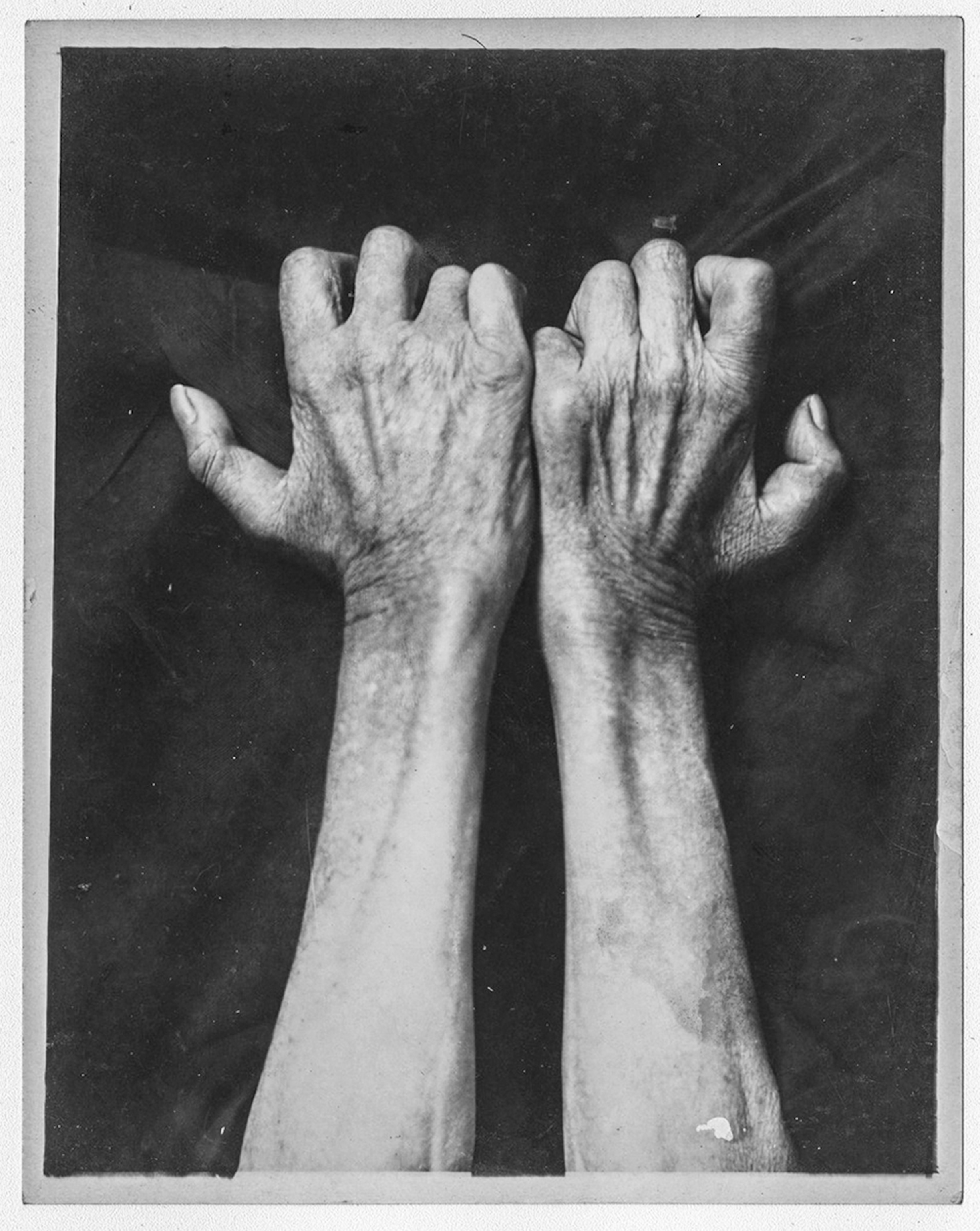 deformed hands.