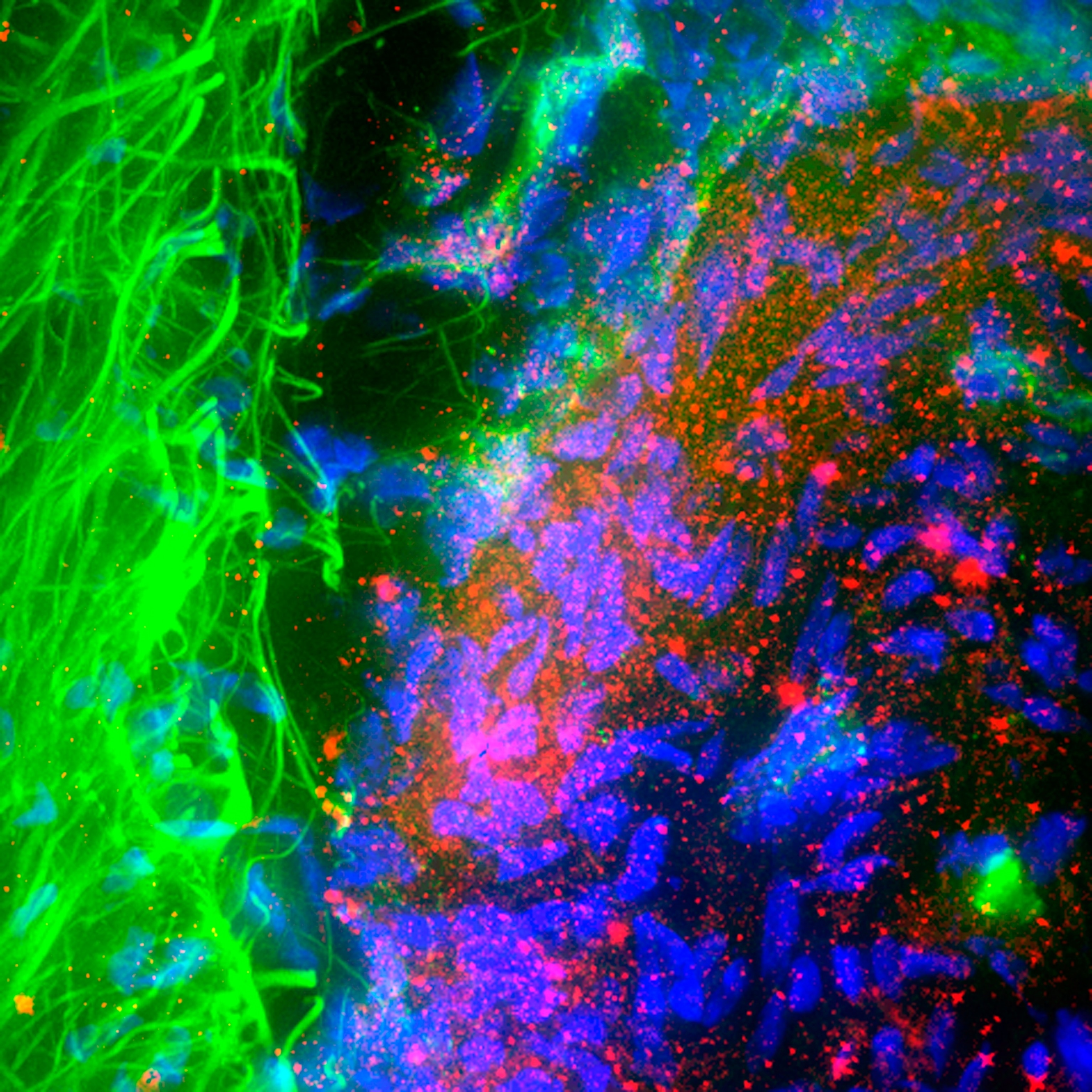 A fluorescent microscopic view of brain cells from a patient with Parkinson's disease. Blue amorphous bodies seem overwhelmed by hundreds of smaller red dots.