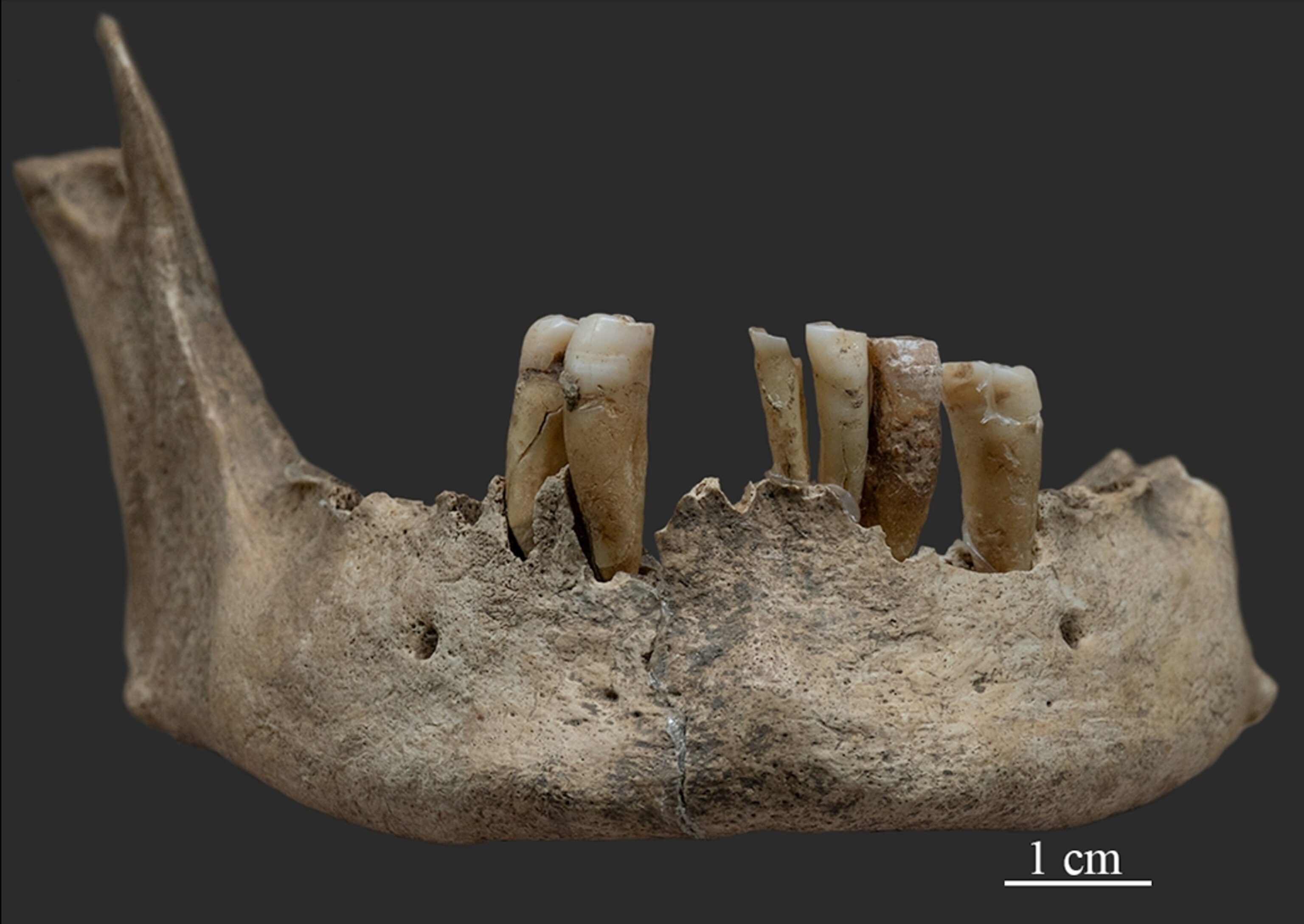 Detailed views of a lower jaw bone, still containing several teeth.