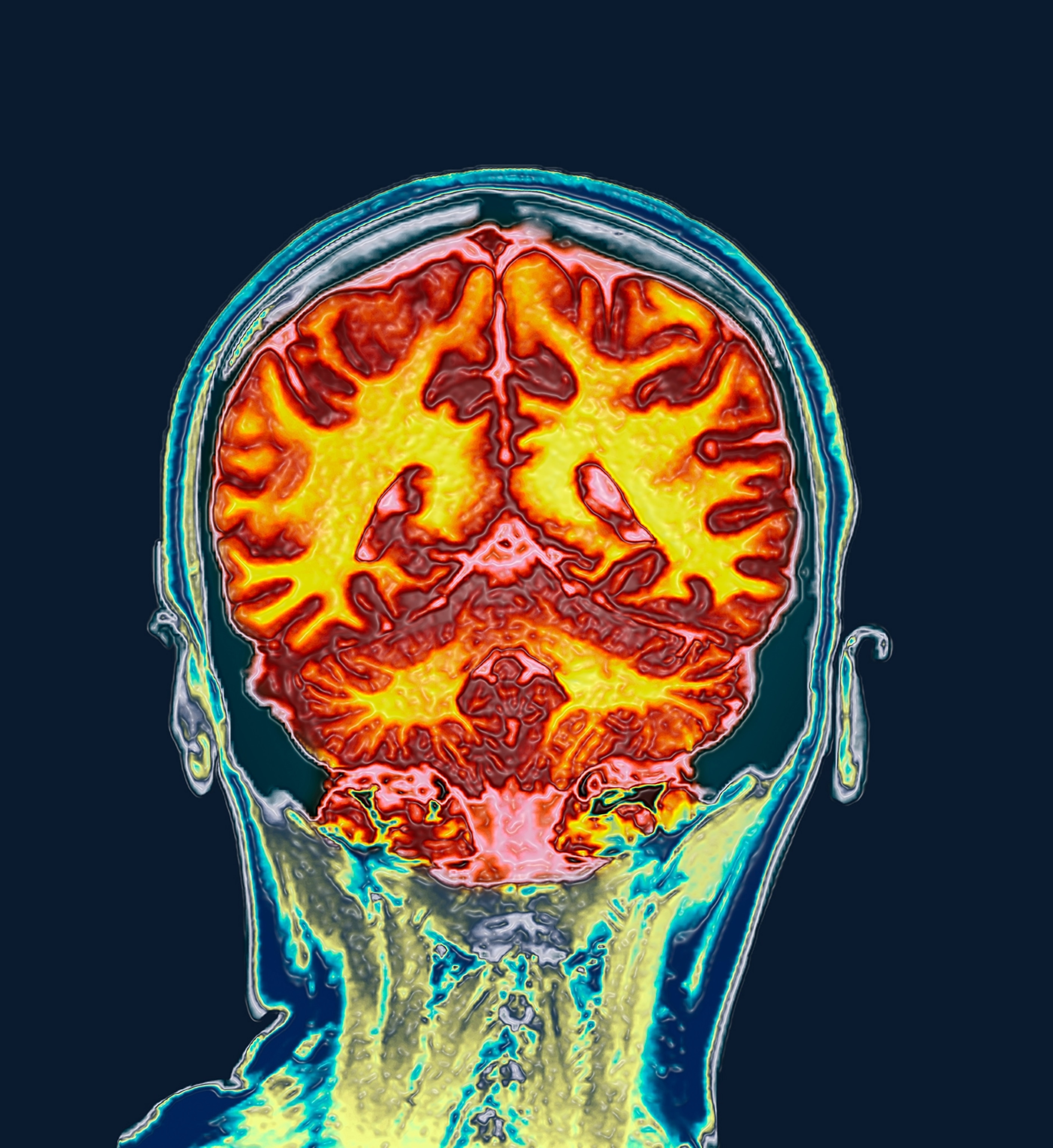 Coloured coronal magnetic resonance imaging (MRI) scan of the healthy brain of a 32 year old woman.