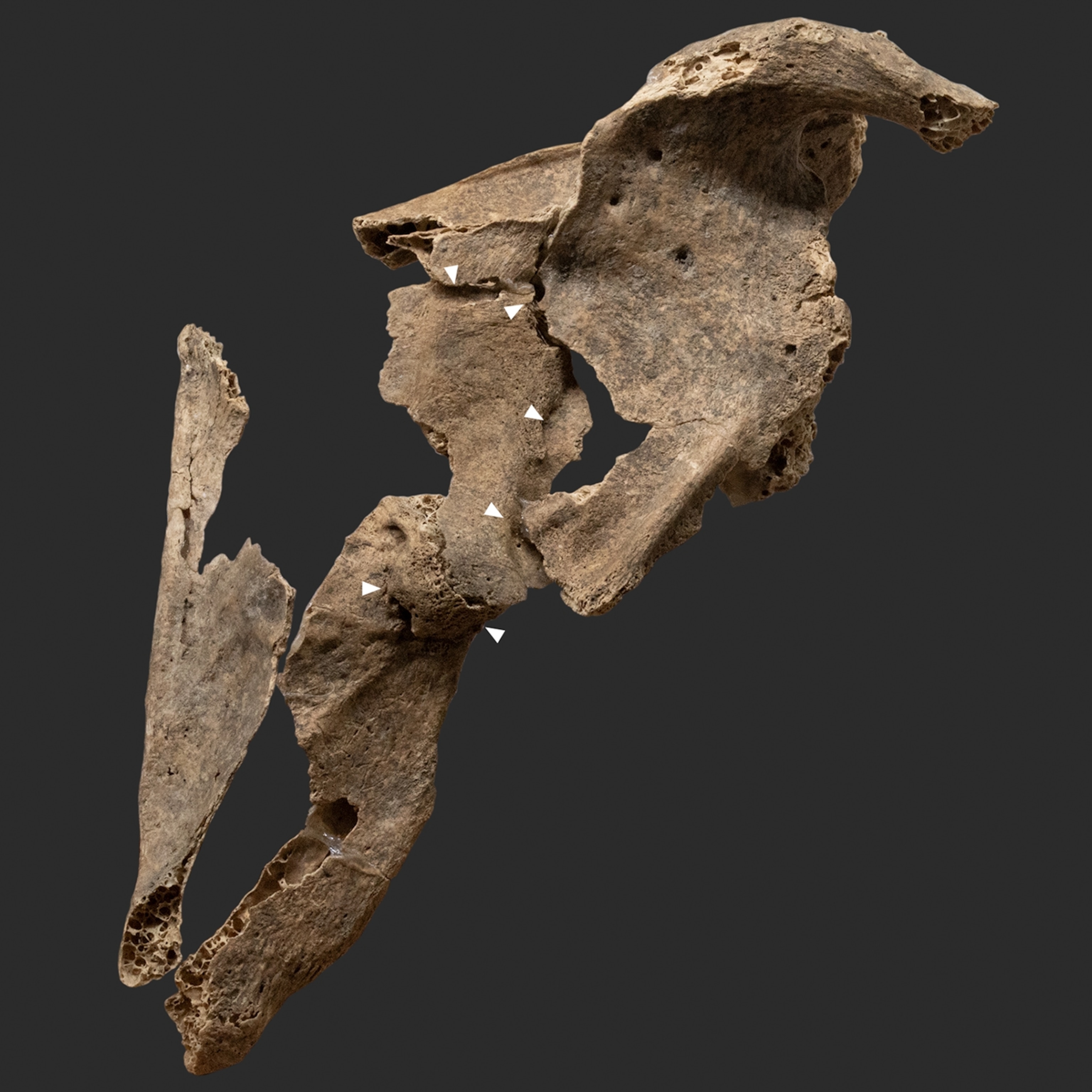 Detailed view of the warrior's left scapula bone, with white arrows highlighting where signs of a healed bone fracture is present.