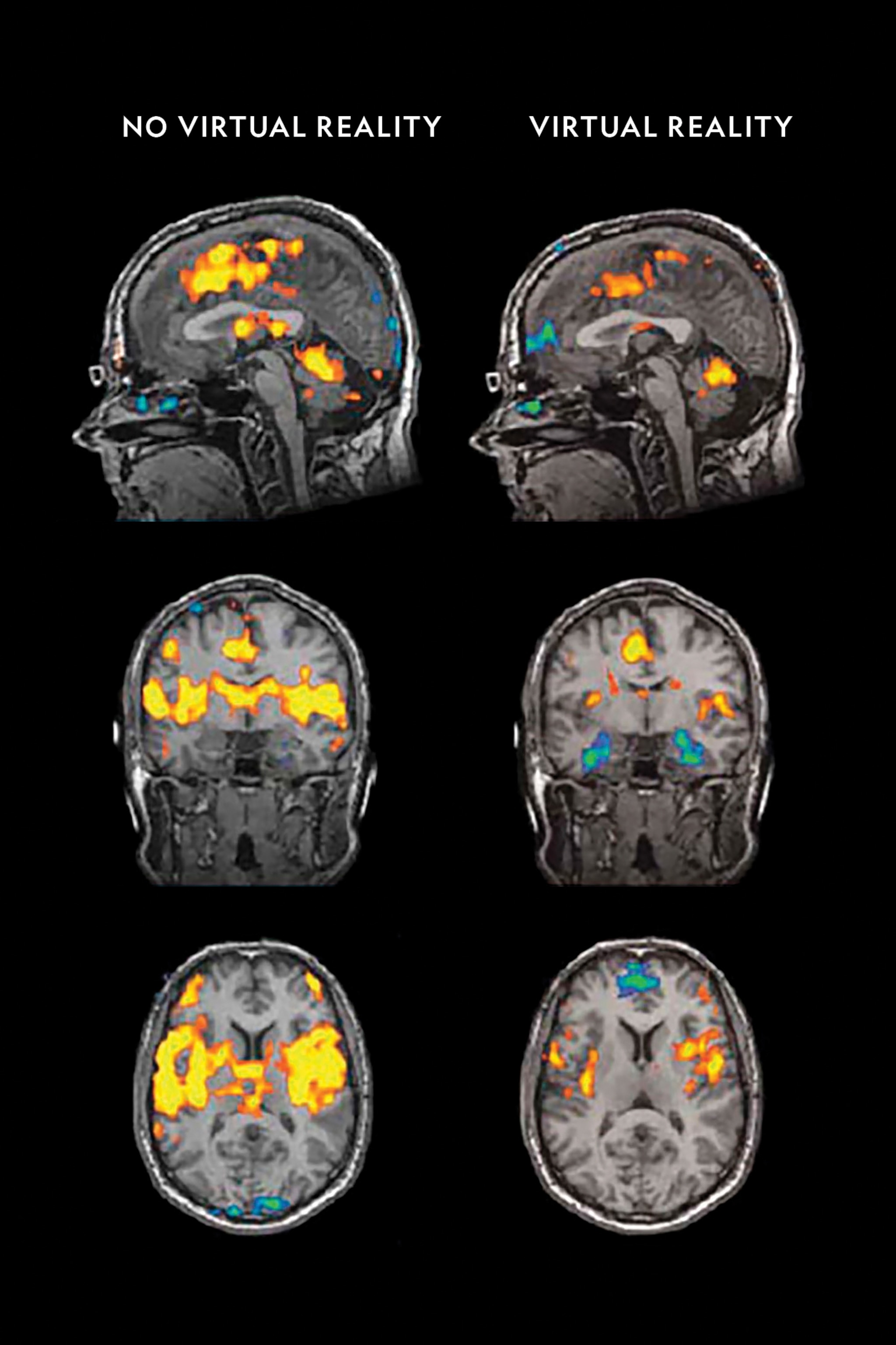 six scans of brain in different positions with different areas highlighted