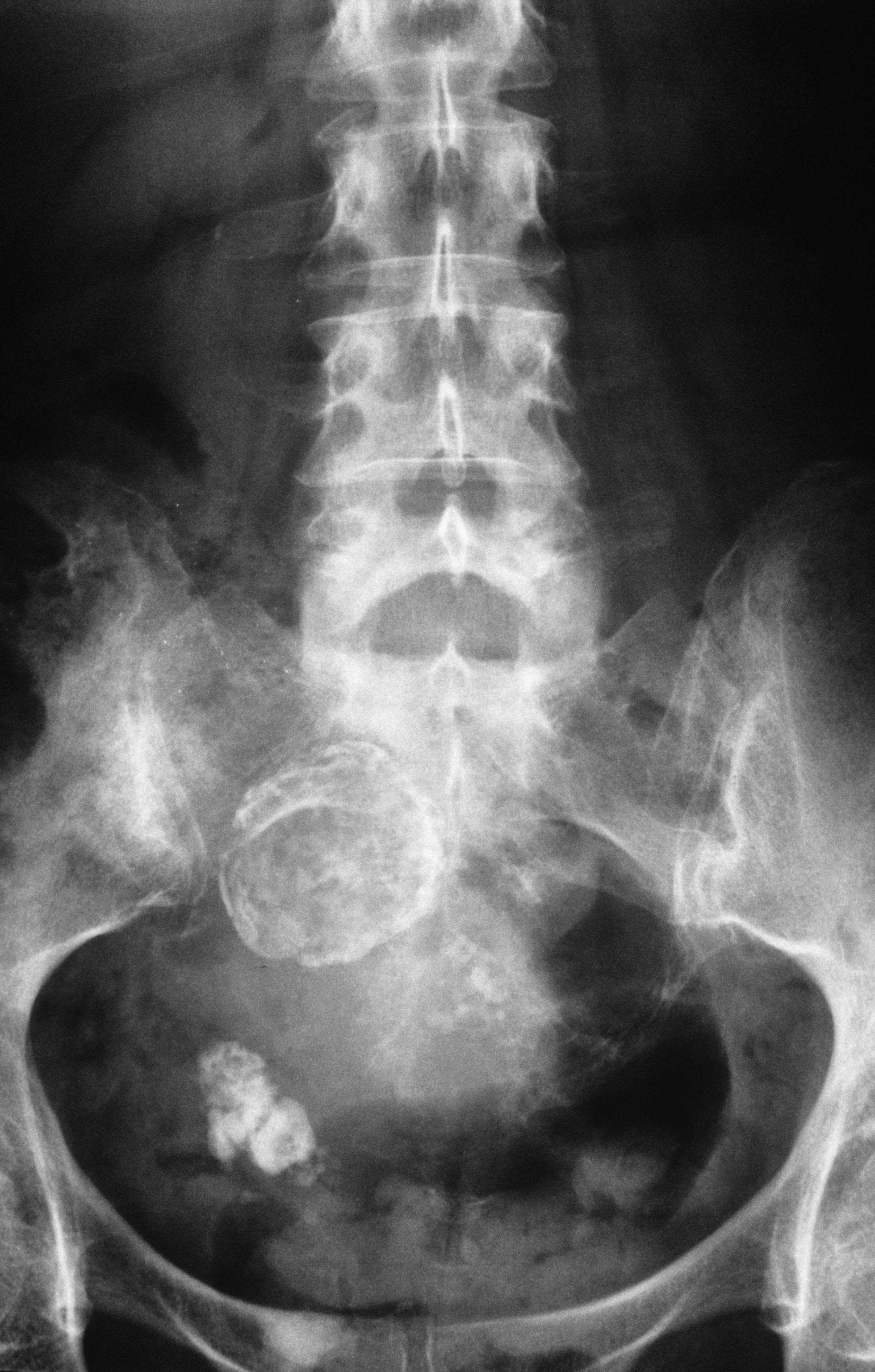 A pelvic x-ray in which calcified ovarian cysts are visualized as opaque densities in the pelvis.