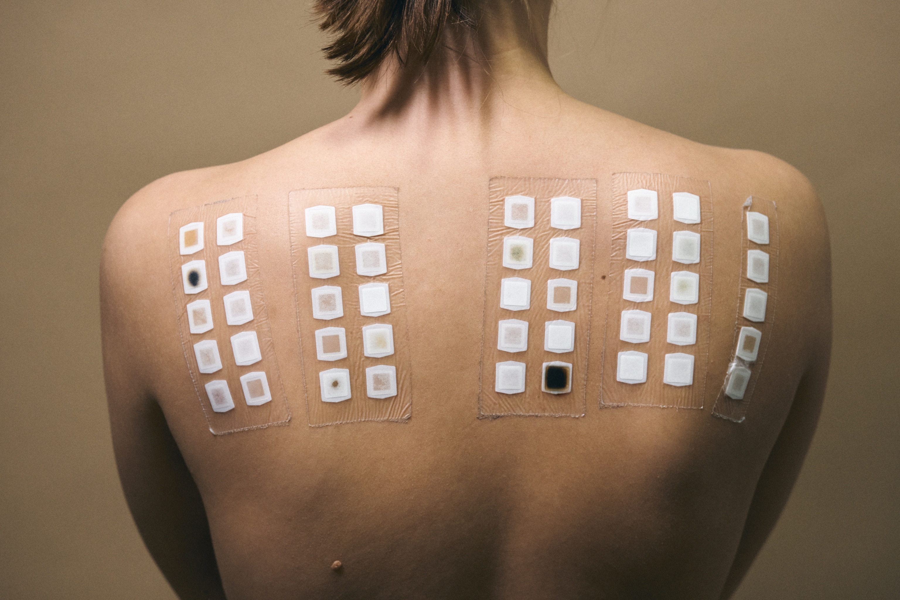 The back of a patient where grids of patches are placed to test for allergic reaction.