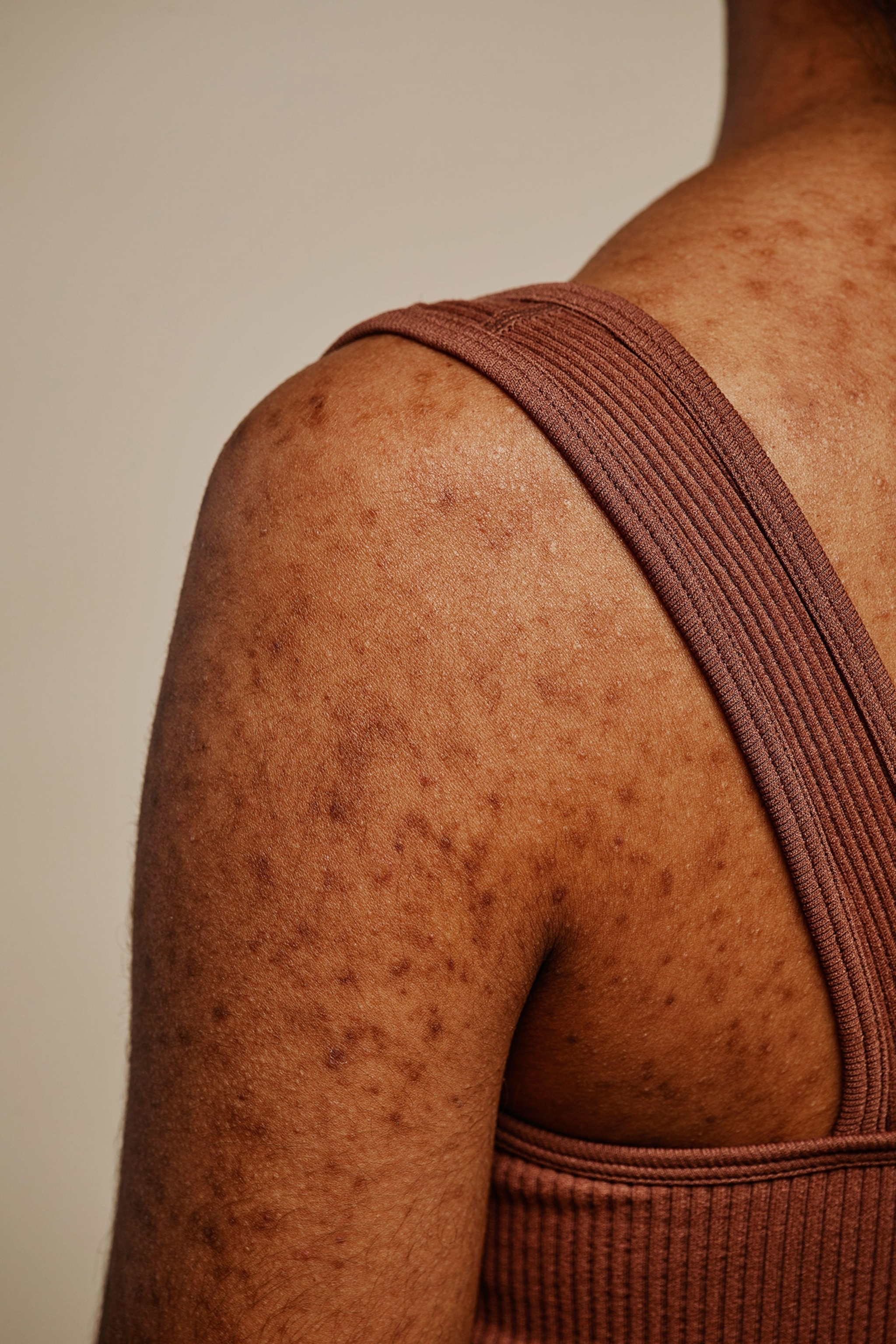 A photograph of the back of a woman with back acne.