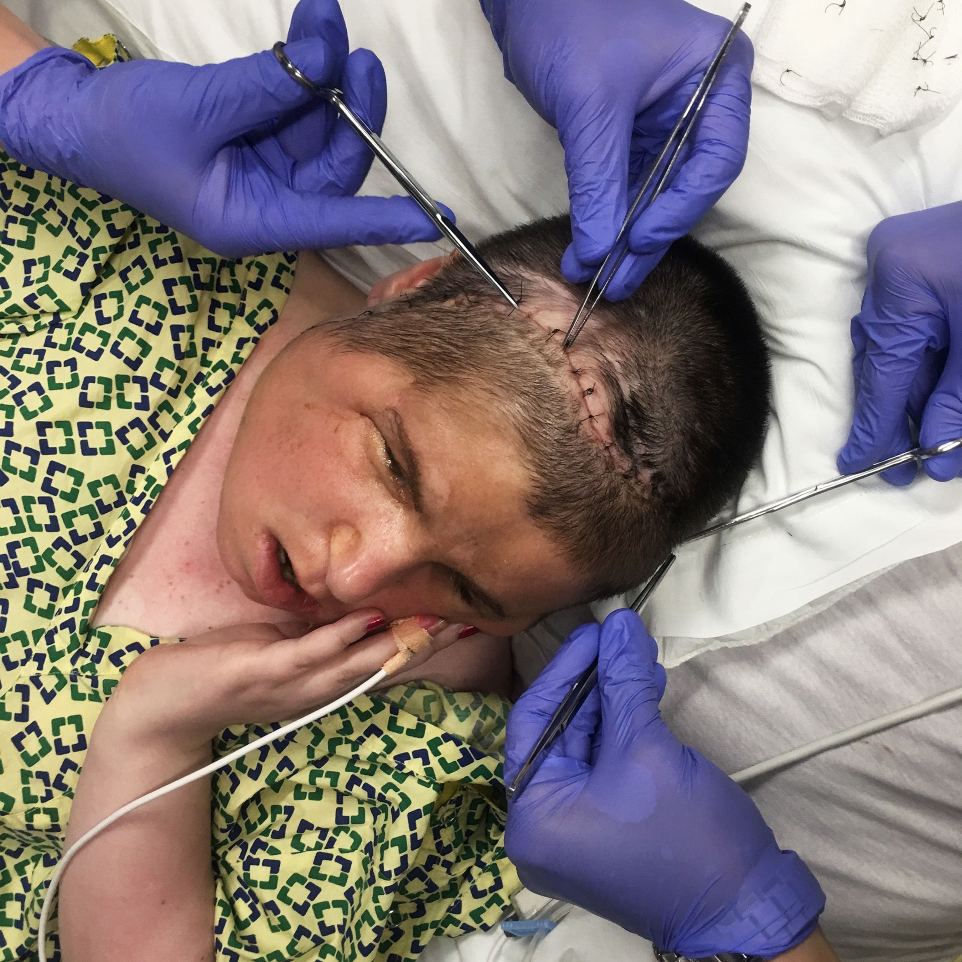 a woman getting stitches removed