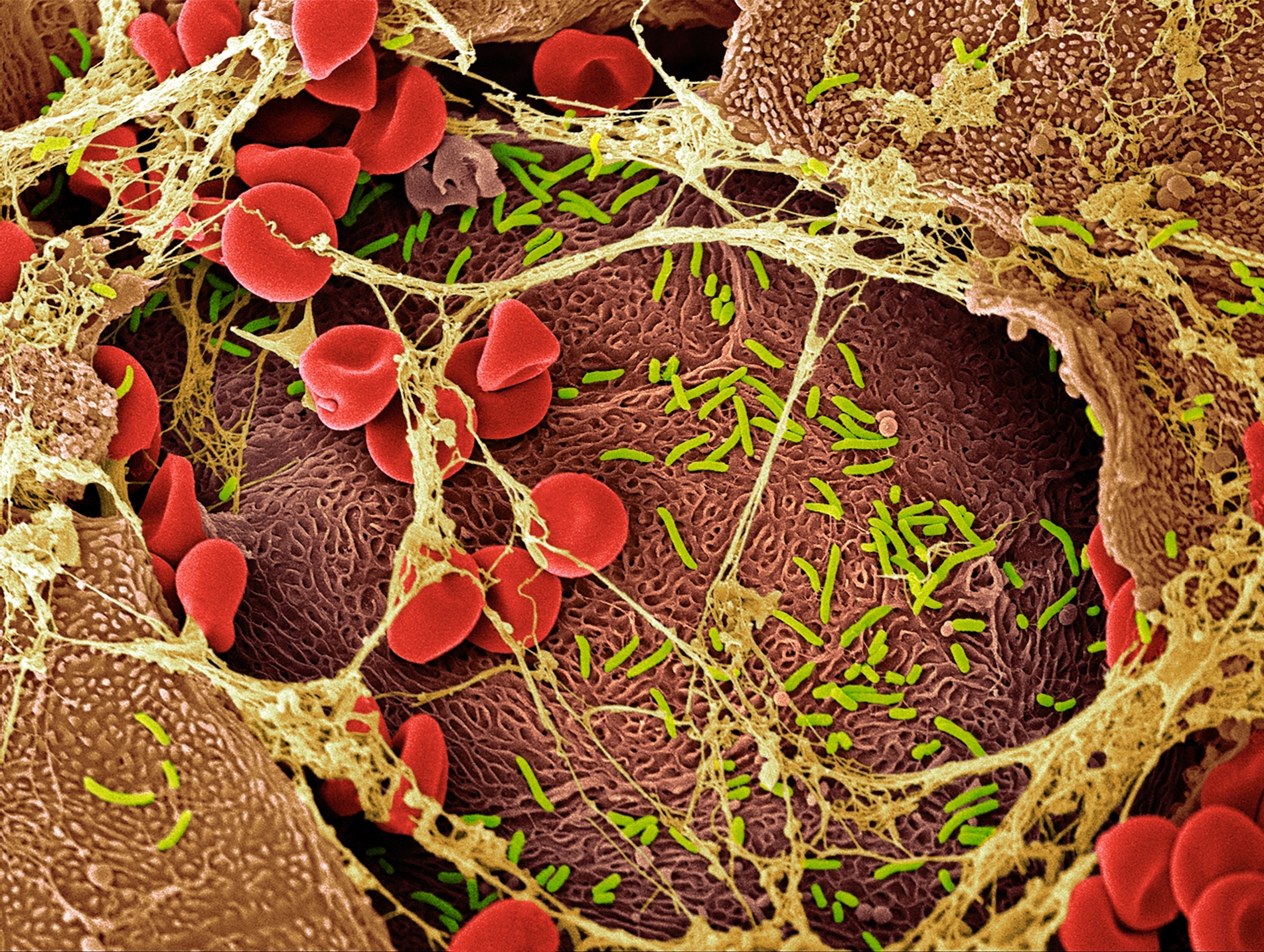 A colorized micrographic view of of various bacteria found on a vaginal wall in addition to dozens of red blood cells.