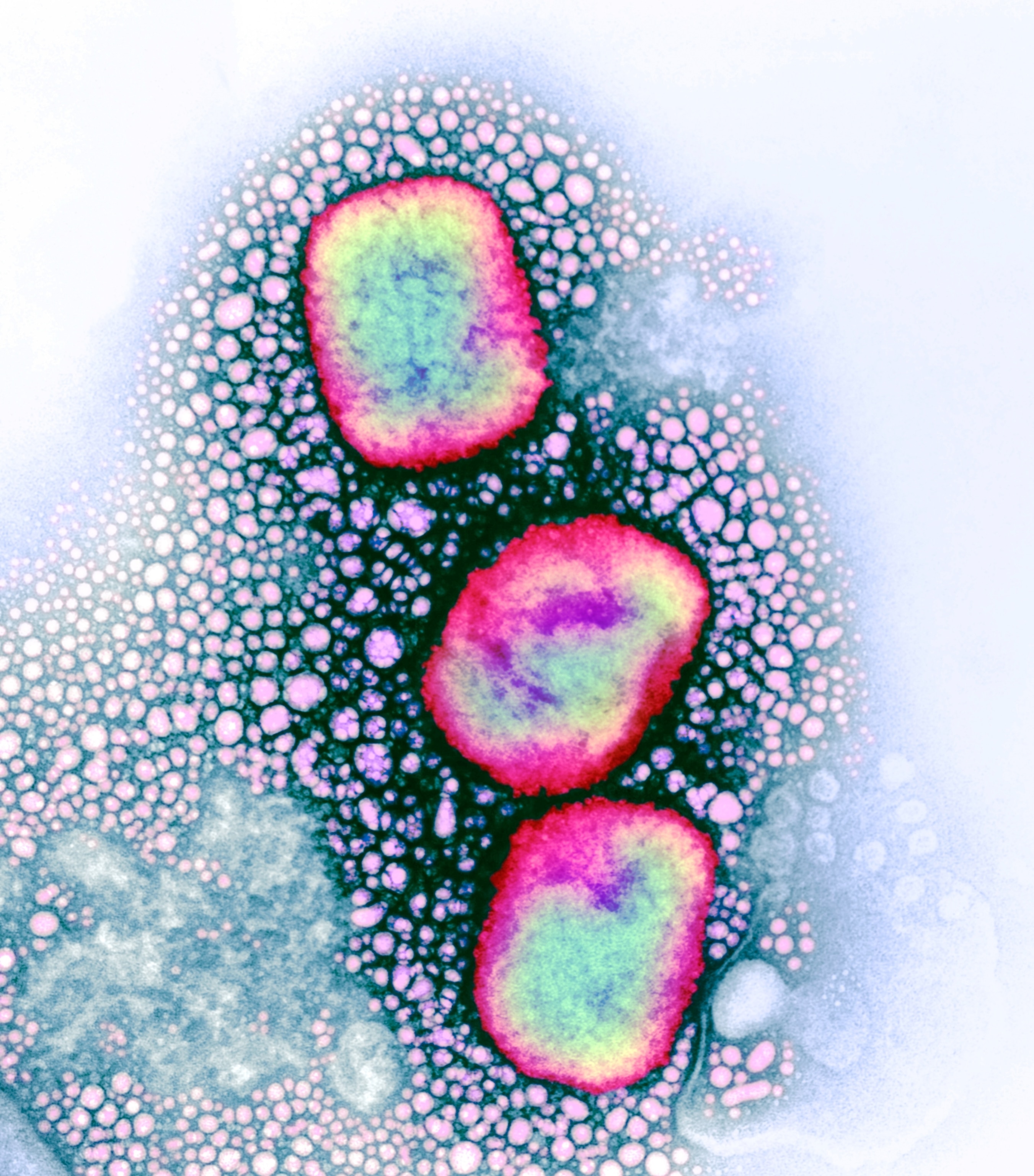 A colorized microscopic view of 3 mpox particles, highlighting the lipid envelope in pink-red and the DNA in blue-green.