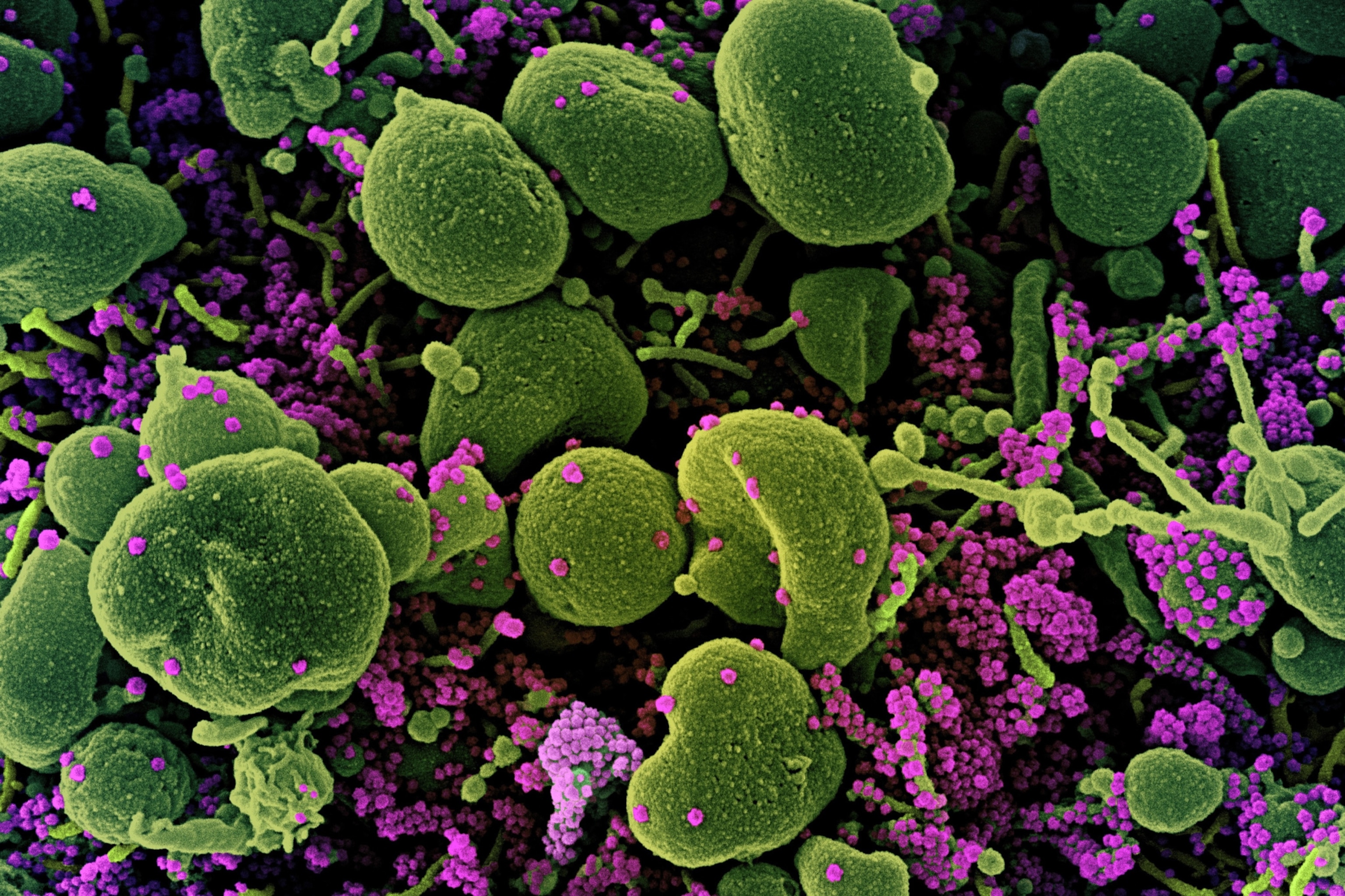 Colorized scanning electron micrograph of an apoptotic cell (green) heavily infected with SARS-COV-2 virus particles (purple), isolated from a patient sample. Image captured at the NIAID Integrated Research Facility (IRF) in Fort Detrick, Maryland.