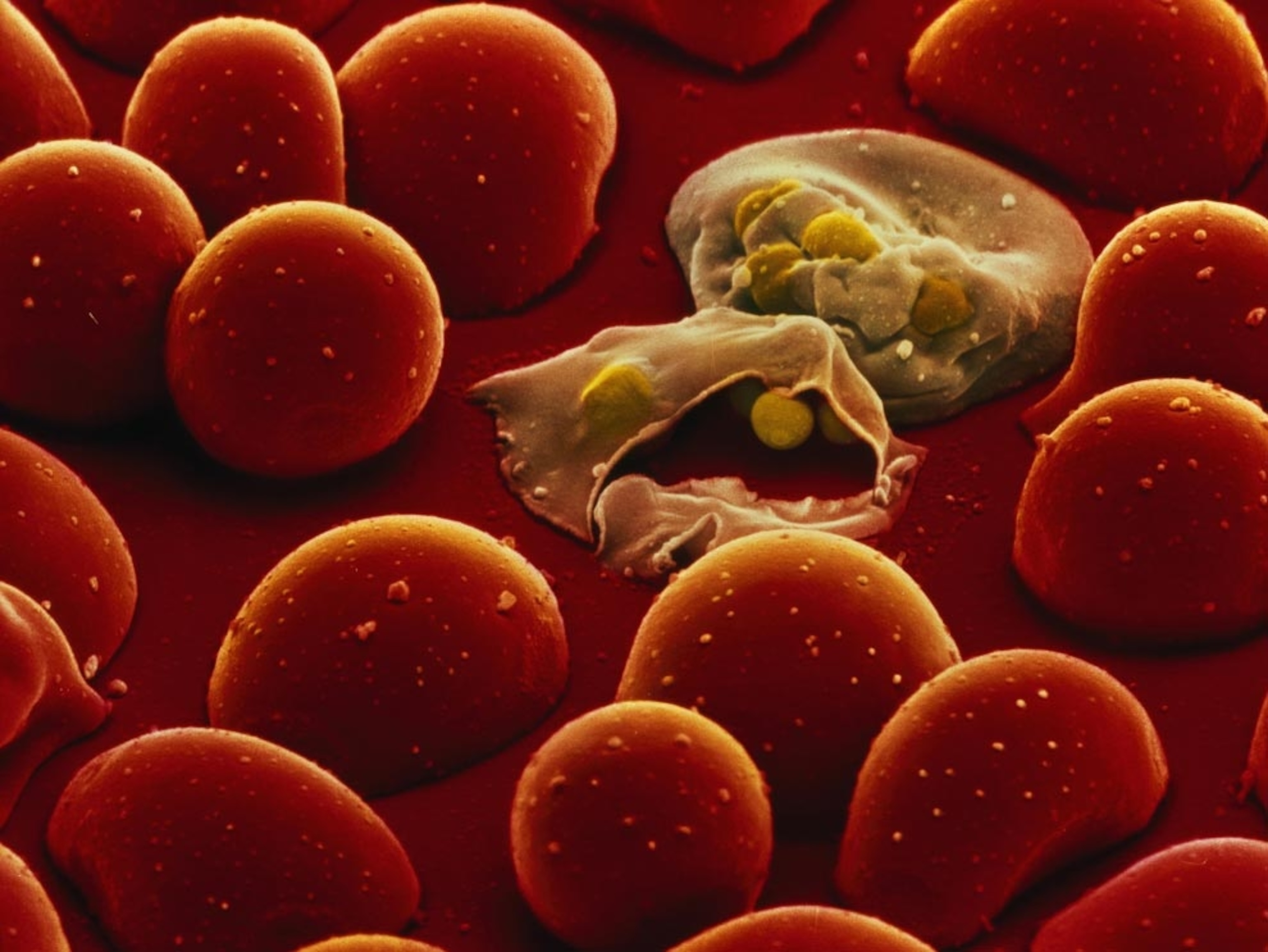 Malaria parasites amid red blood cells