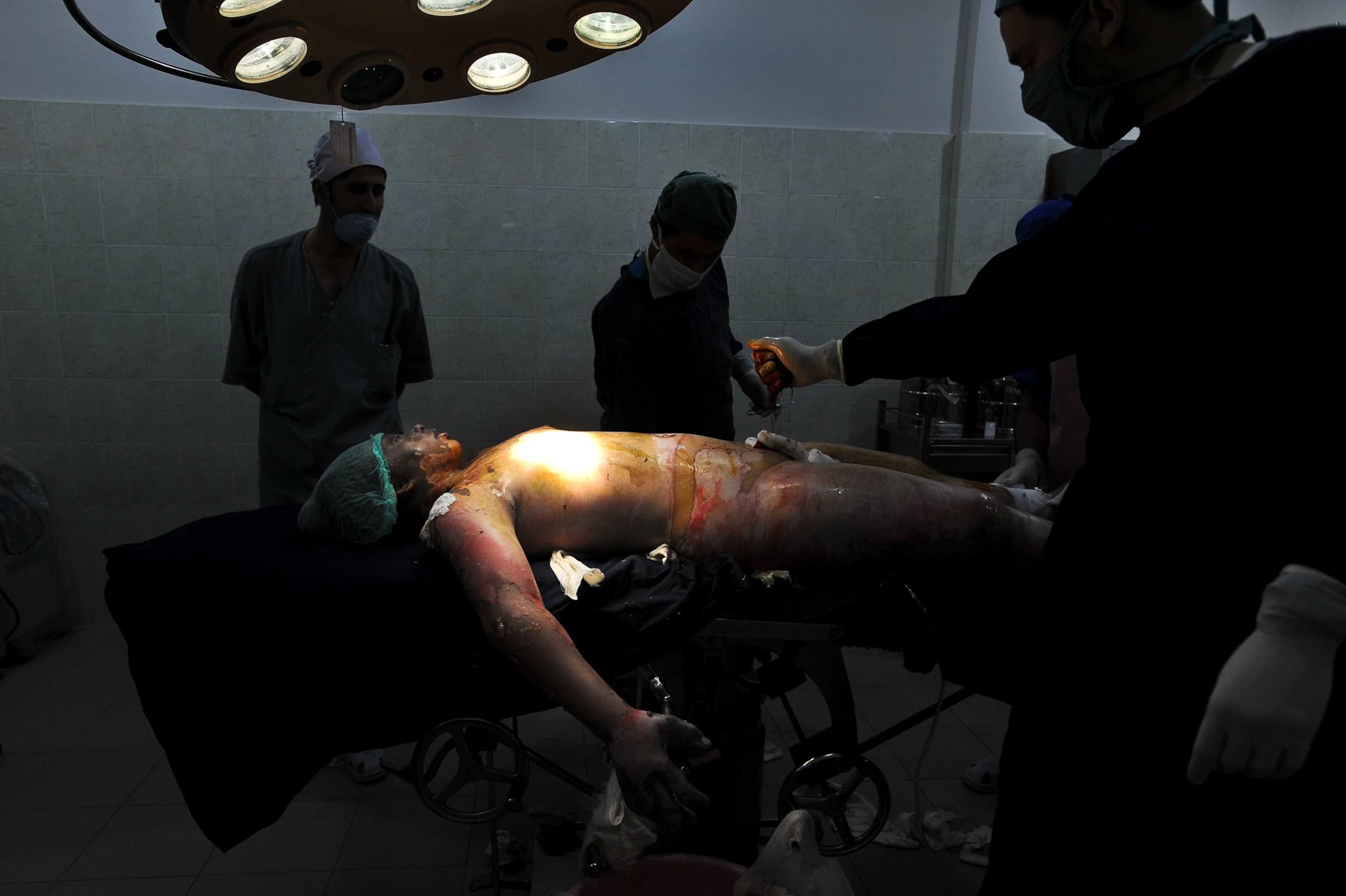 doctors trying to save a 15-year-old who set herself on fire, at a hospital in Kabul