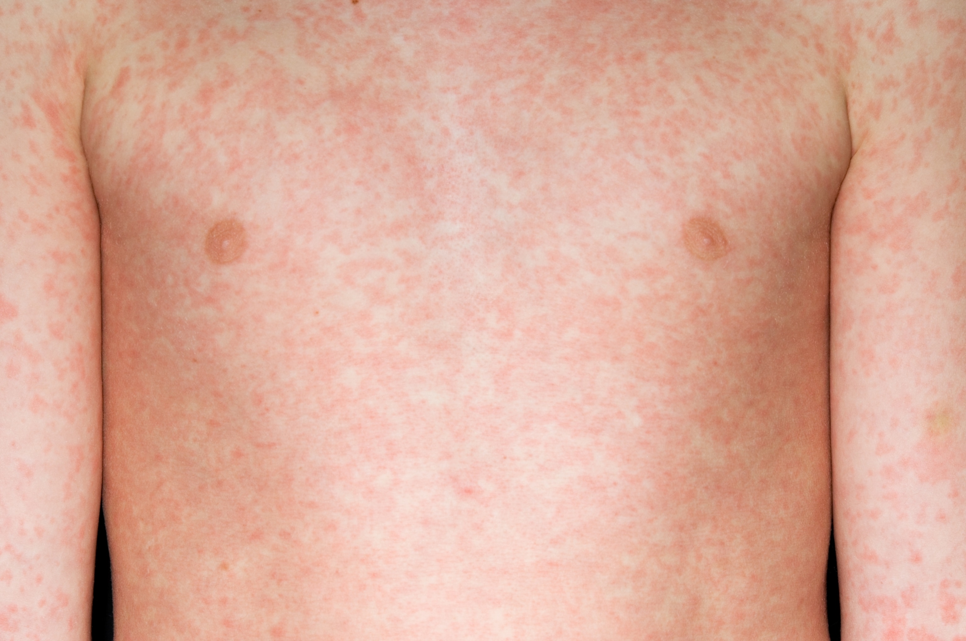 The trunk of a young boy, covered in a red rash