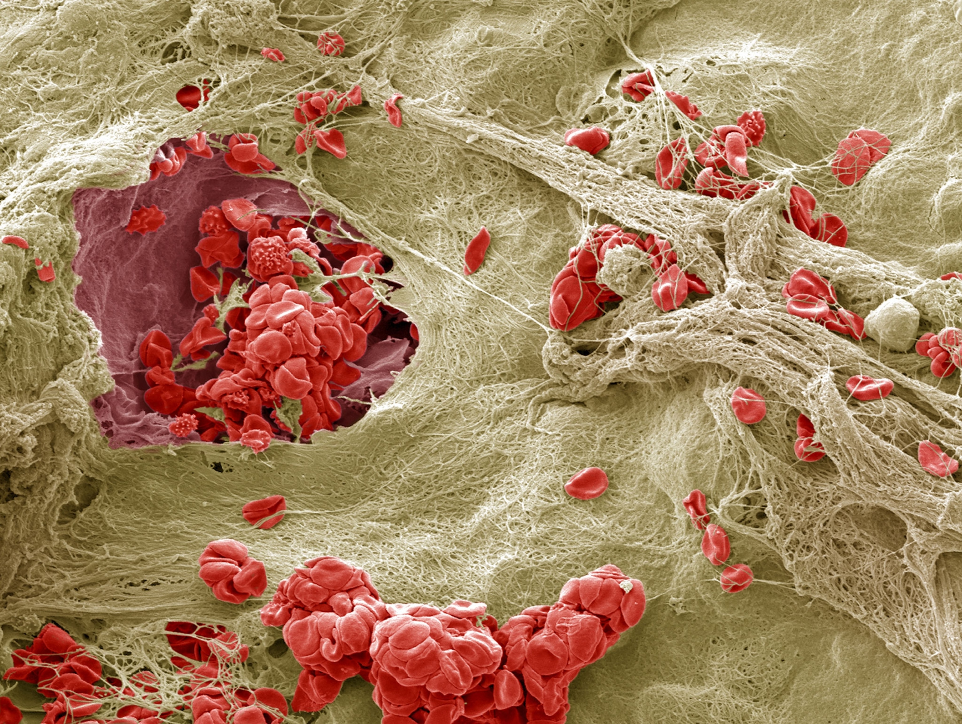 Red blood cells, represented by red, circular groups and single red ovals, are becoming trapped in a mesh of the protein fibrin, which is beige in color.