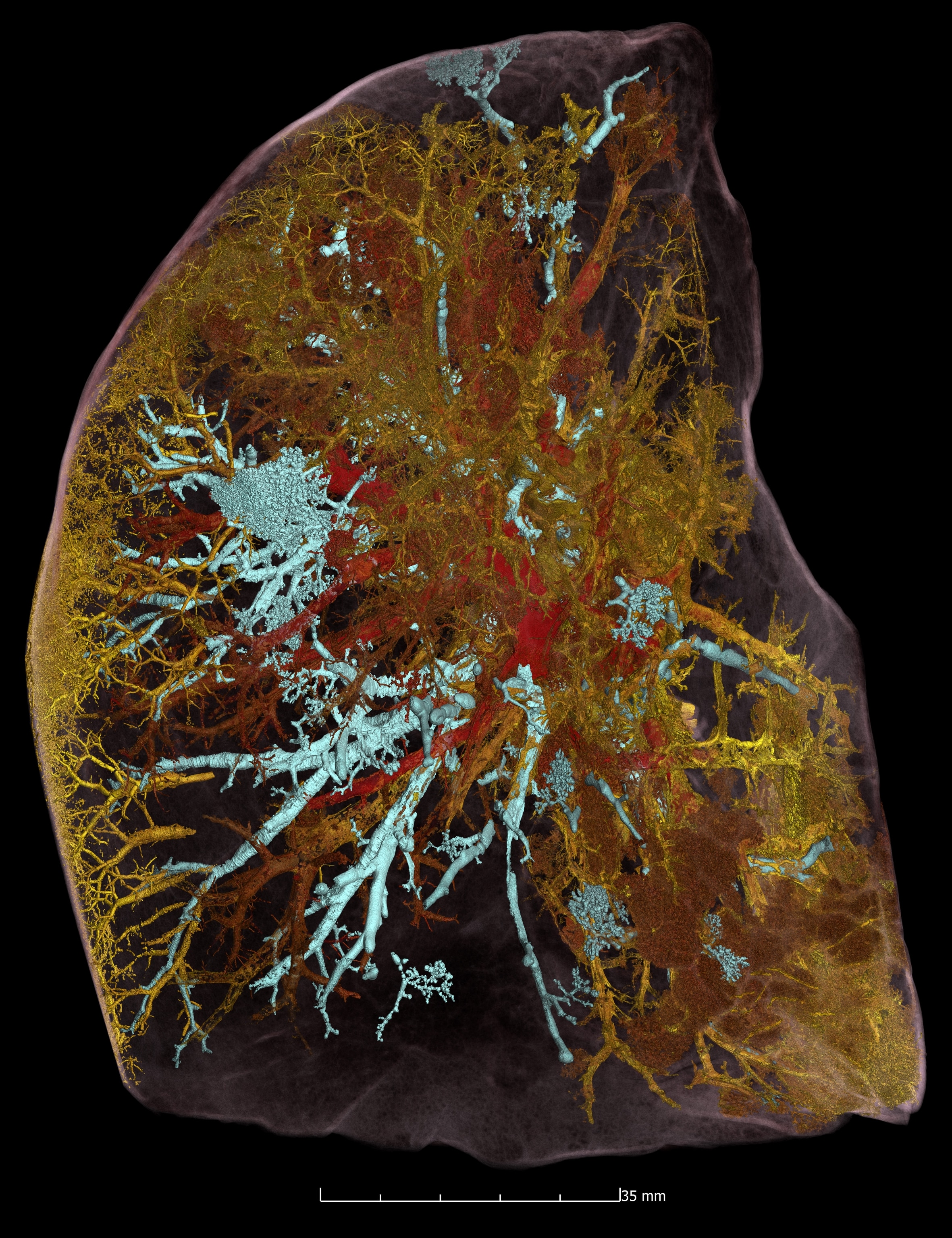 Left lung of a patient who died of COVID-19.