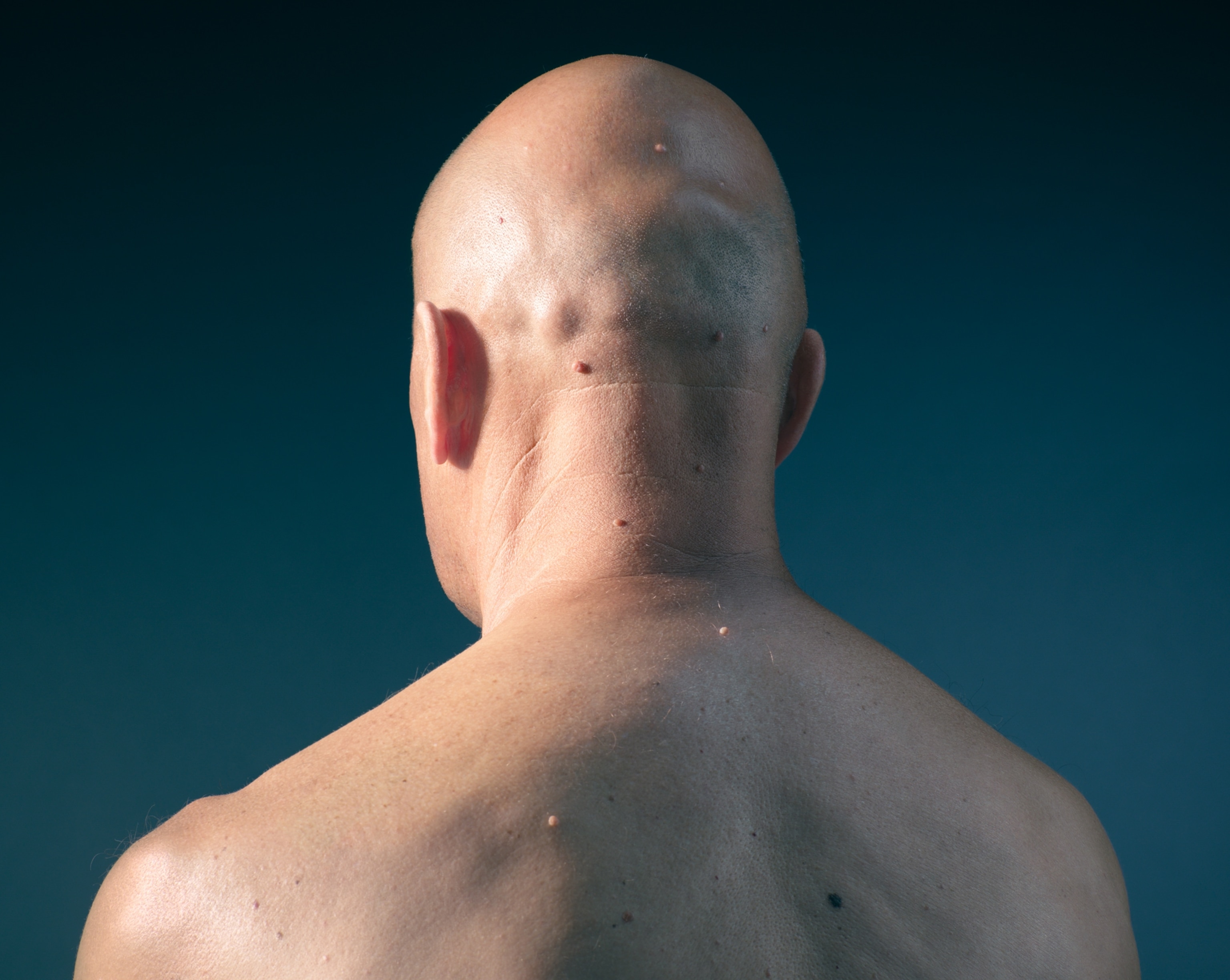 The back side of a bald man's head and shoulders.