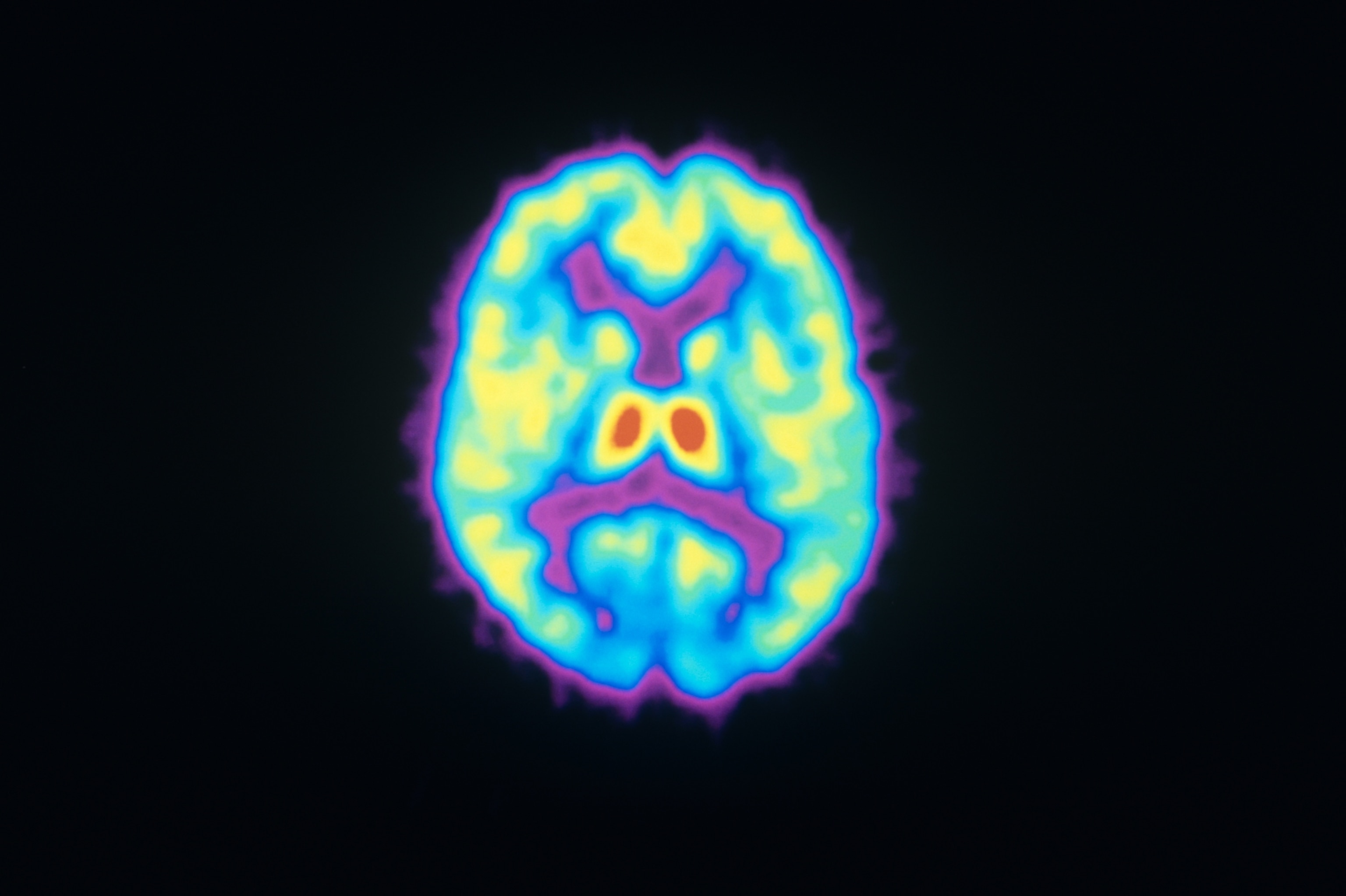 A colorized Positron Emission Tomography (PET) scan showing the distribution of opioid receptors in the human brain.