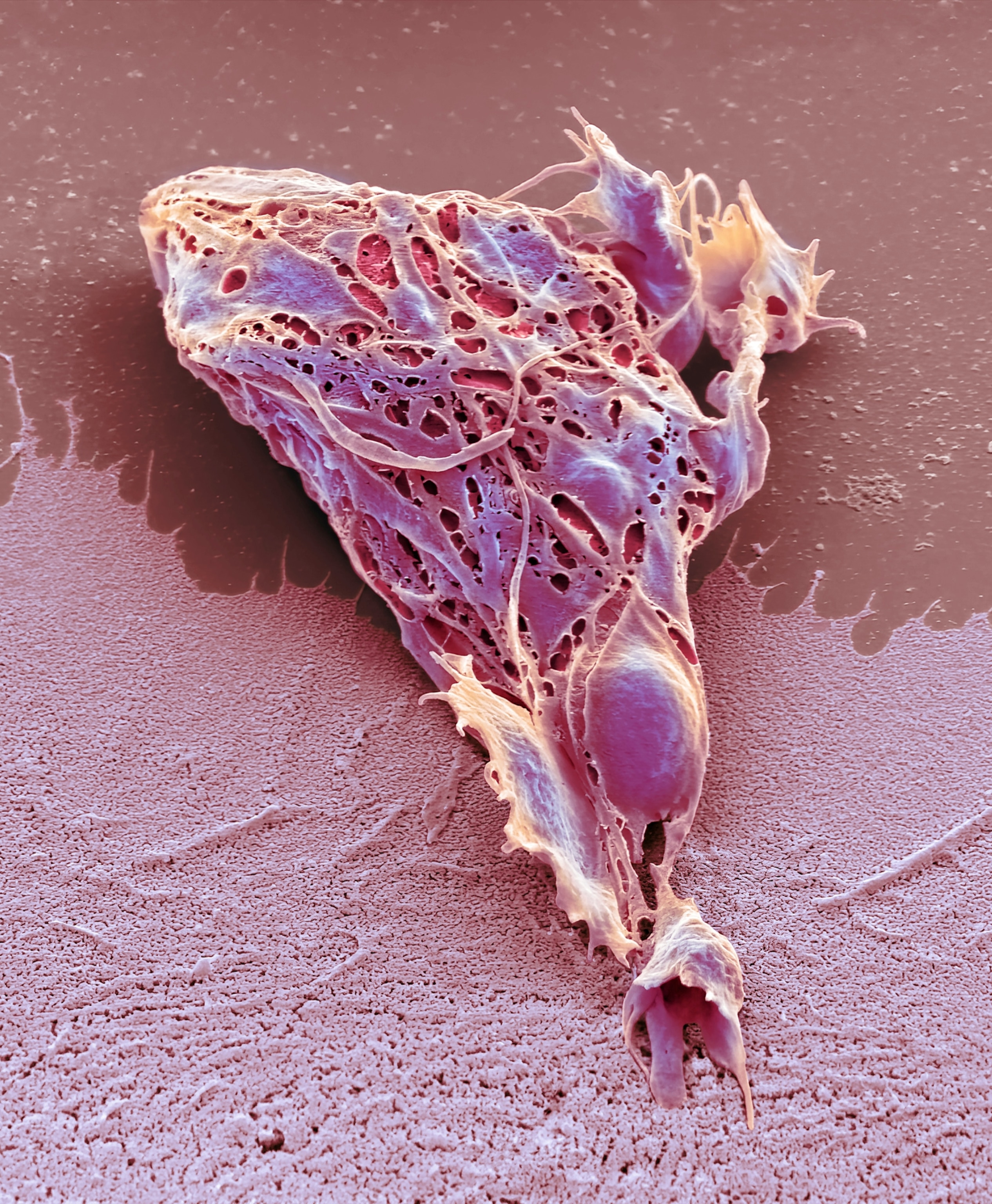 Chemotherapy induced cell death. Coloured scanning electron micrograph (SEM) of a cultured cancer cell (HeLa) treated with doxorubicin to cause necrosis.