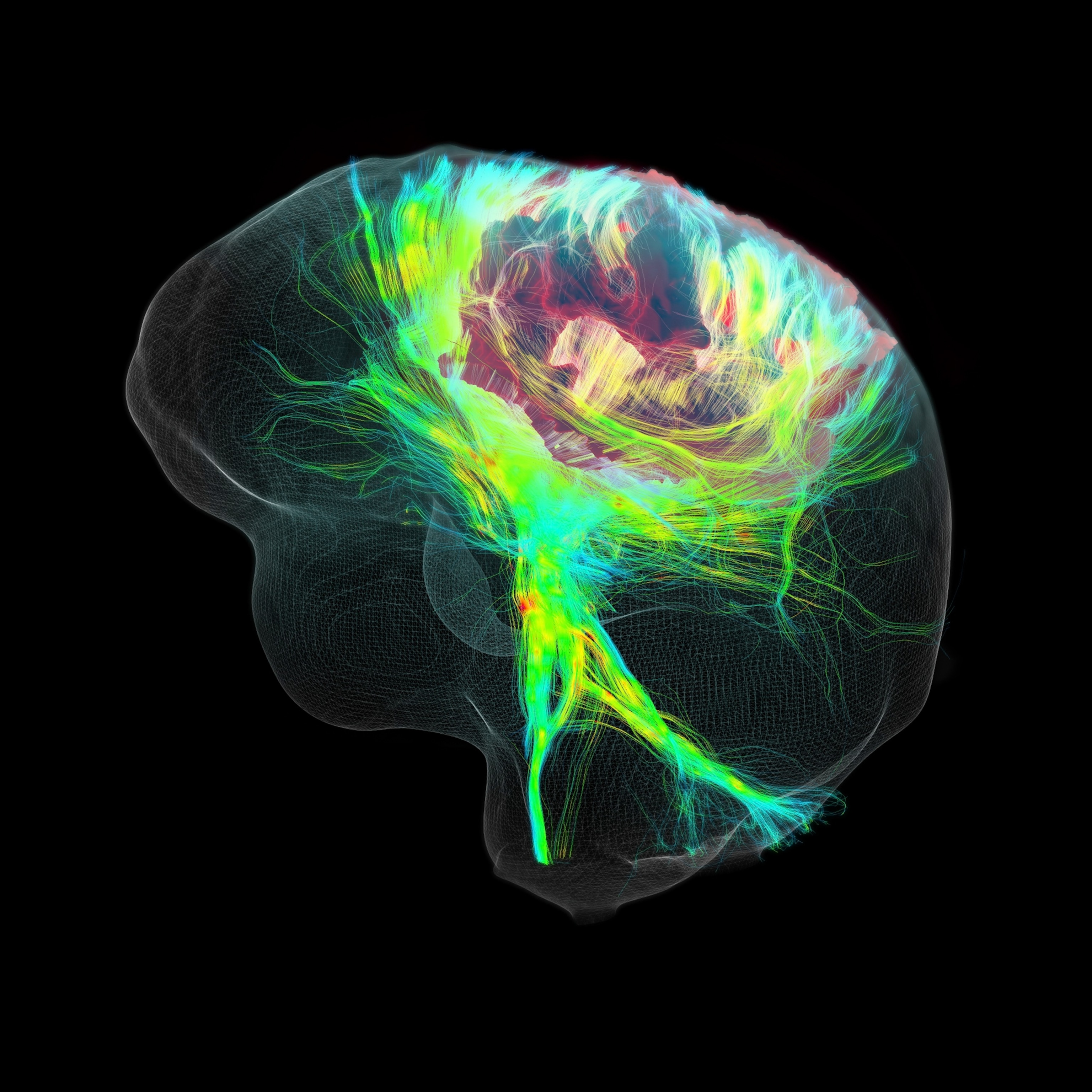 A 3D scan of a the brain of a patient with a glioblastoma. Nerve fibers are colorized as strands of bright green and blue, but an area of the upper right portion of the brain is cloudy and red.